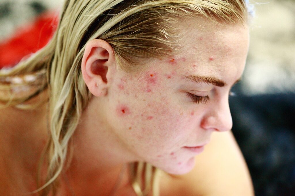 Young woman in profile with red acne breakouts on her cheek, representing pimple patches and acne care